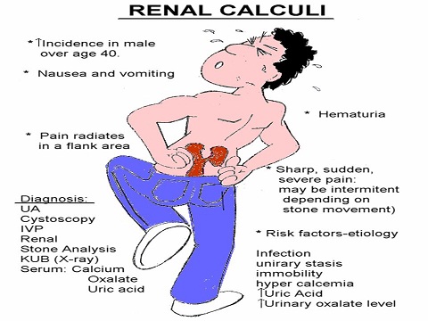 right renal calculus