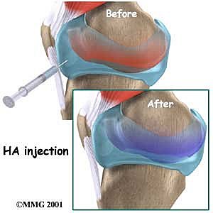 Cortisone Shot On Tour Cortisone Shot On Tour