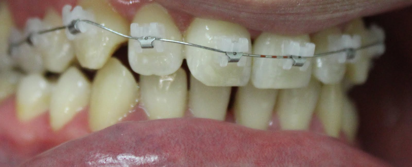 Ortodontia Pinhais, Dr Marcio Matos