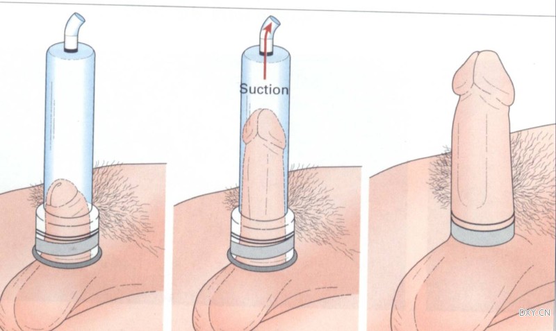 Помпа для пениса Smile купить со скидкой в секс шопе  Вакуумные помпы  Мужские помпы
