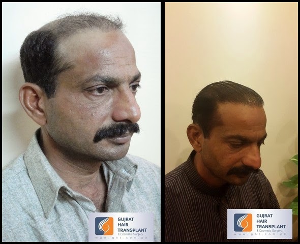 Fue Pakistan Fue In Pakistan Fue Hair Transplant In Pakistan