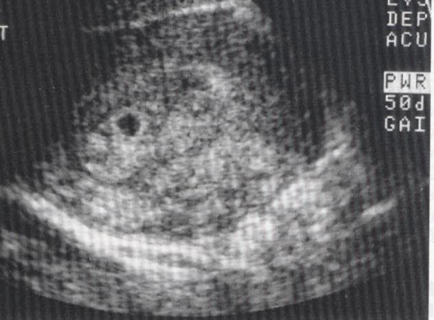Hình ảnh bình thường siêu âm thai 3 tháng đầu