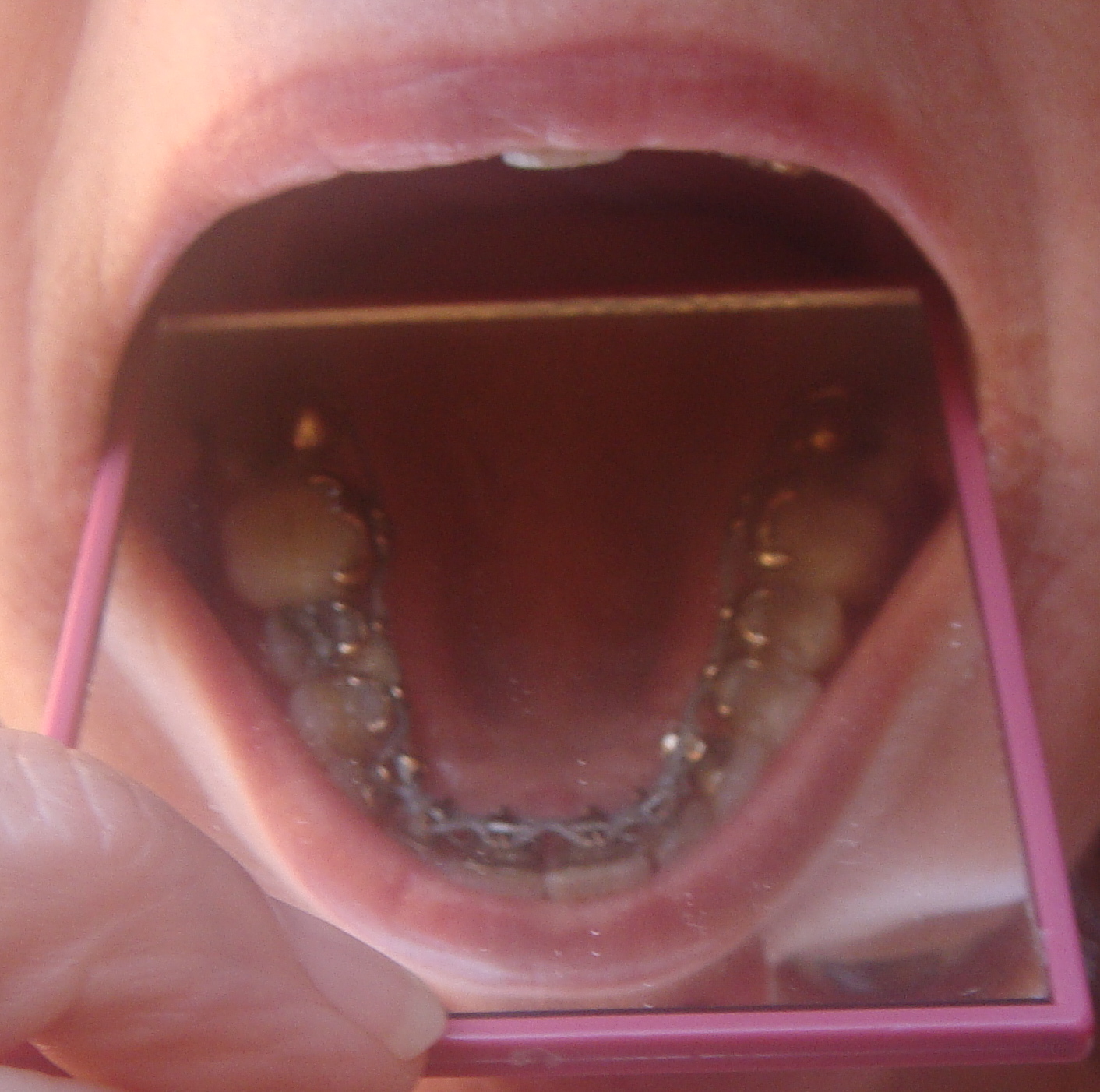 Braces at 56 Incognito Braces Nudging Canine Tooth Into Place. Plus