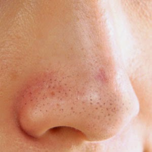 Cara Alami Menghilangkan Komedo Secara Mudah Cara Alami Menghilangkan Komedo Secara Mudah