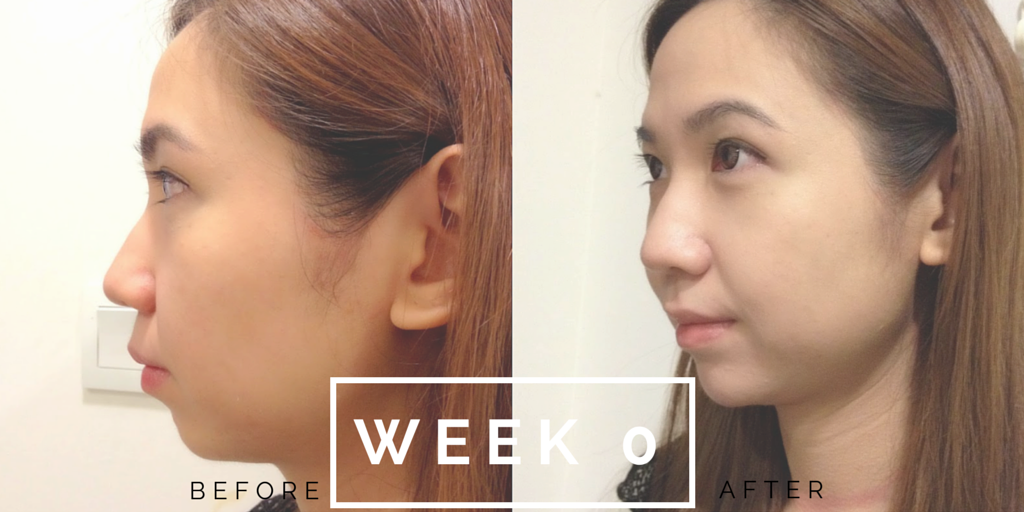 MyClinic Damansara Uptown Aesthetic Treatment Face Reshaping Fillers Botox Review