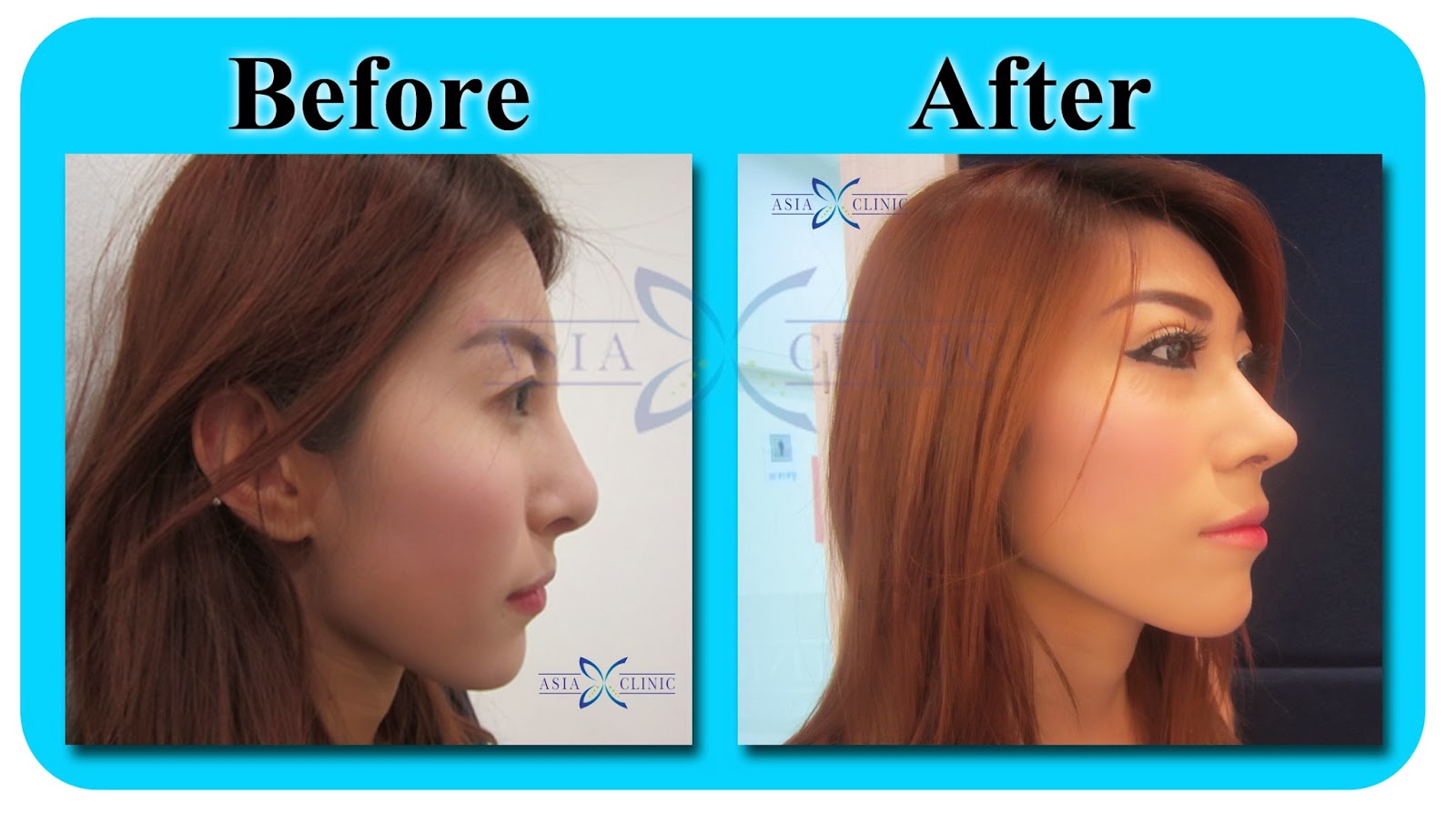 Rhinoplasty Surgery Thailand Nose Augmentation Before And After Photos