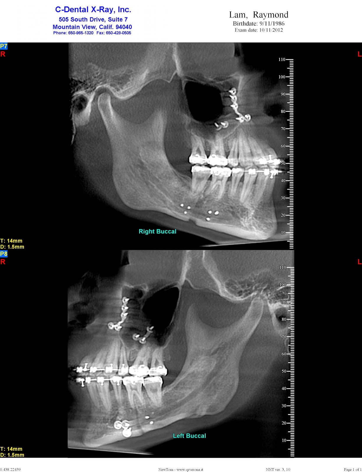 Day 49. 3D Video flythrough of my skull, PostSurgery XRays A Tale