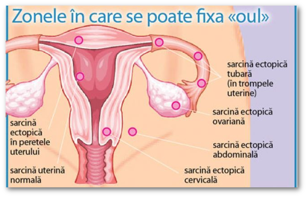 Ce stii despre sarcina extrauterina?