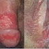 Obat Sipilis Paling Manjur Di Sumatera thumbnail