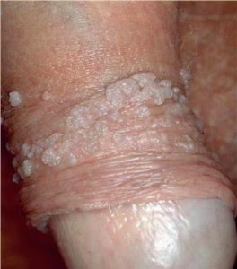 Kutil di penis kutil di penis, kutil di kelamin, kutil di kemaluan