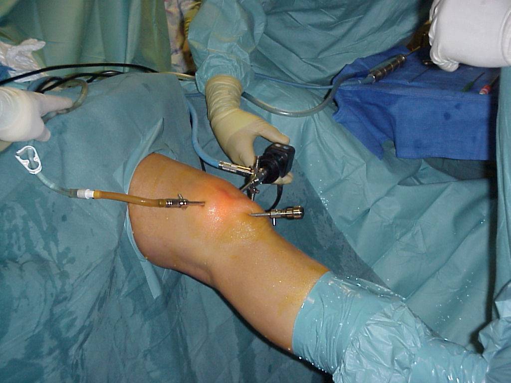 Como é Feita A Cirurgia De Artrose No Joelho Luciano Sousa Fisiologista : Artroscopia Cirurgica Do Joelho