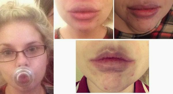 Kylie Jenner Challenge Photos Bruised Lips caused by Viral Trend of Internet