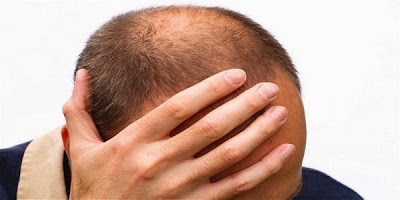 mengatasi-rambut-rontok