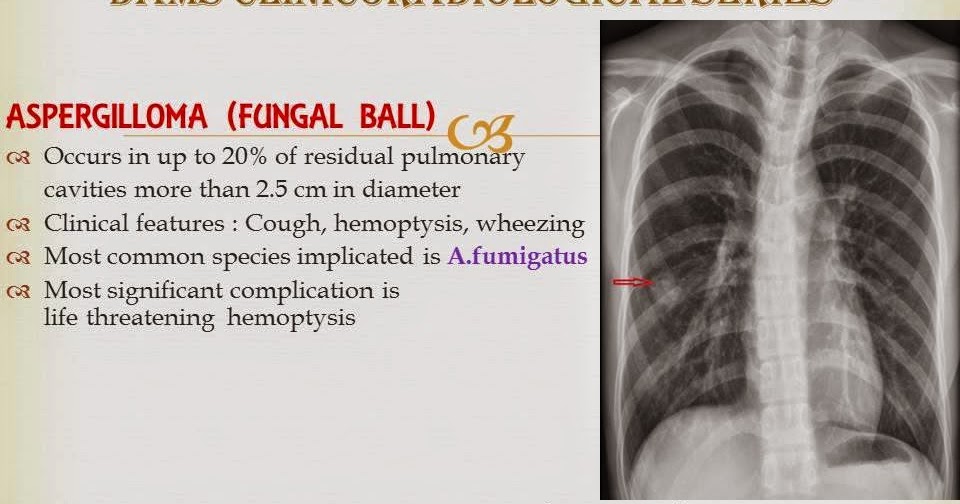 Aspergilloma: Clinicoradiological Series - Radiology Imaging