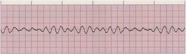 Kasus Gawat Darurat Ekg Abnormal