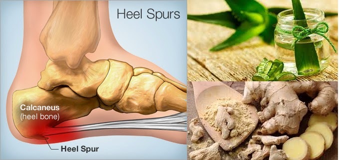 Tolong Beritahukan Ini Pada Orang Orang Disekitarmu Inilah Ada Obat Herbal Yang Ampuh Sekali Mengatasi Sakit Tumit Melebihi Ramuan Dokter