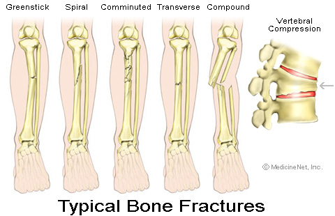 broken bones. How-to-heal-a-roken-one