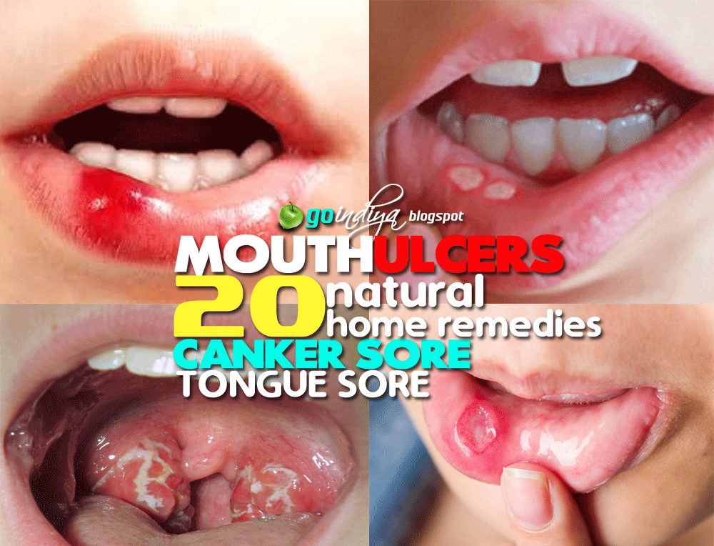 Mouth Ulcers (Canker sore/Tongue Sore) 20 Best Home Remedies for Fast