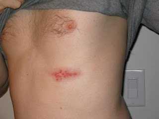 Herpes Zoster Tratamiento Herpes Zoster Tratamiento