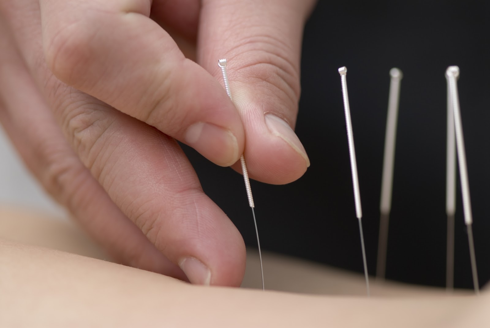 Acupuncture Needle Gauge Chart