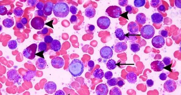 Leucemia Mieloide Crônica (LMC) | Biomedicina Online
