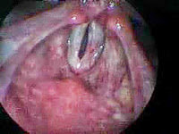 hipertonía laríngea