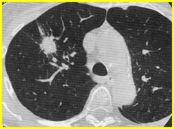 radiation and ct scans radiation and ct scans