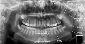 Adult+Mandible+-+Orthopantogram+%2528OPG%2529.jpg