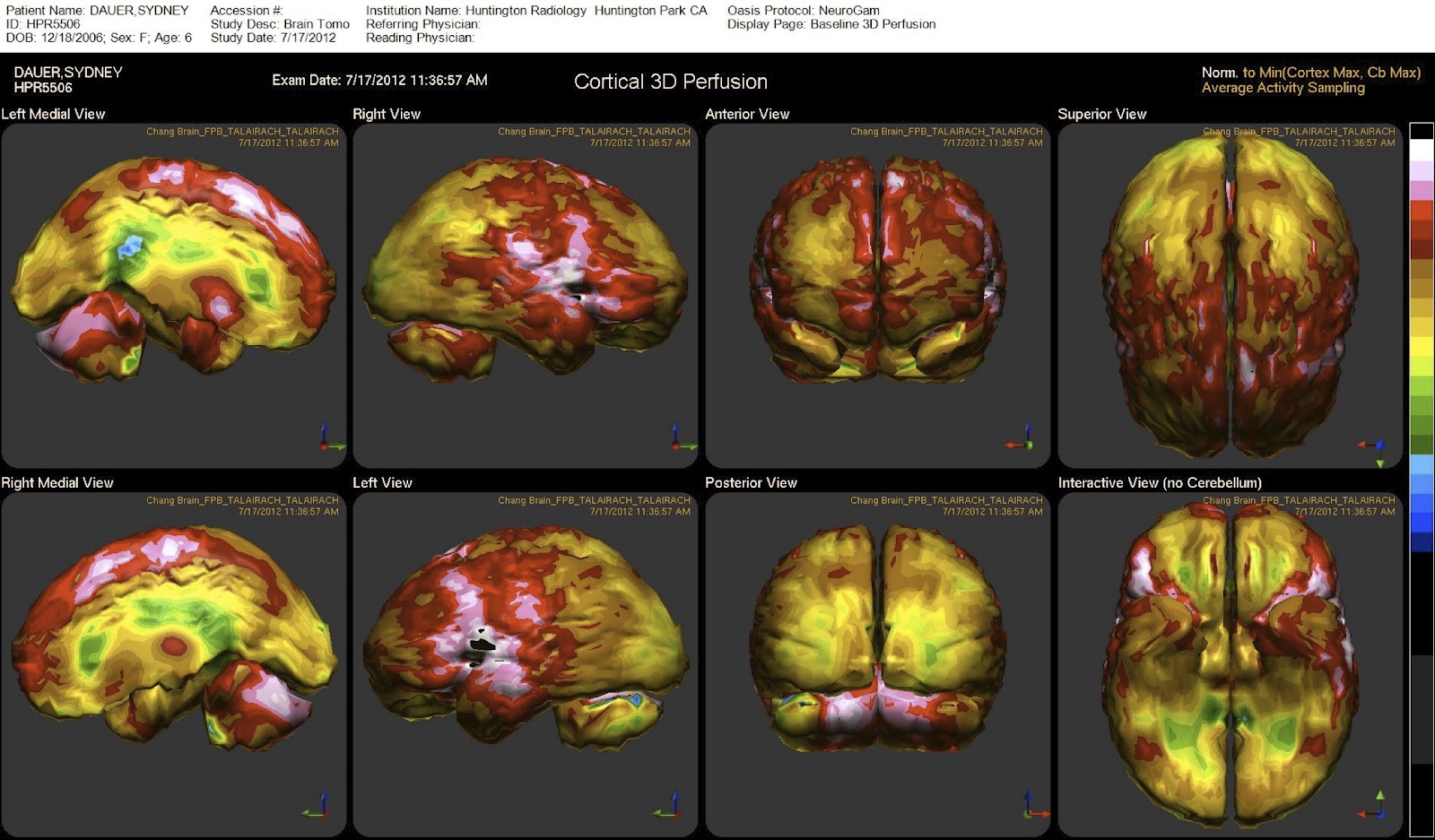 All this time, we were told it was Autism!!! SPECT Scan 7/17/2012