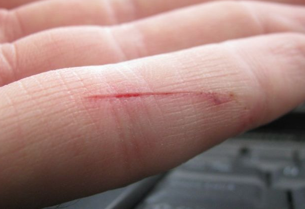 Tangan Luka Terkena Pisau Cuba Petua Ini Abang Terlajak Laris