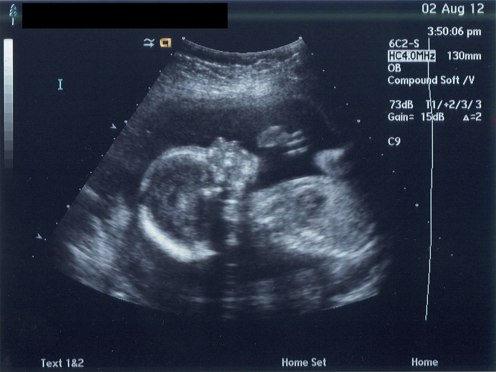 Week 9 Ultrasound