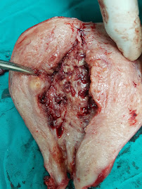 Endometrial hyperplasia -TAH done by Dr. Alaa Mosbah