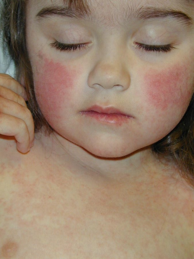 HEALTHCARESMV HEALTH SKIN RASH