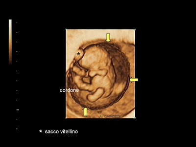 Se è possibile giocare sport durante emorroidi