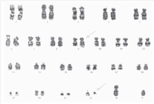 DE CITOGENETICA DE LEUCEMIA MIELOIDE de citogenetica de leucemia mieloide: