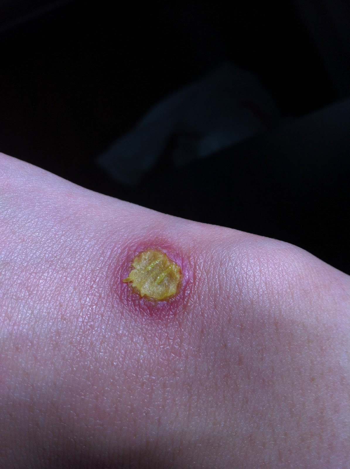 Wound Pus