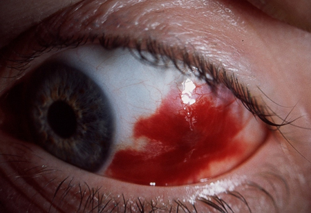 Subconjunctival Hemorrhage Photos