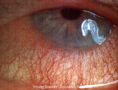 Young Doctors Research Forum Images For Conjunctival Xerosis