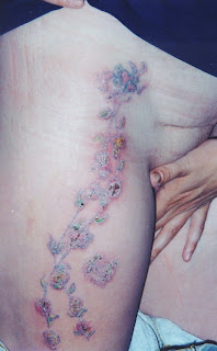 Infected Tattoo Pictures
