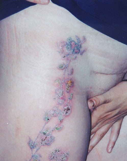 infected tattoo pictures to pin on pinterest tattooskid infected tattoo pictures to pin on pinterest tattooskid
