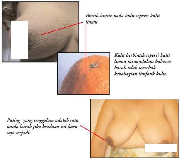 Gambar Kanser Barah Payudara Kanser Barah Payudara