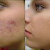 Causes of Acne | Symptoms of Acne | Prevention of Acne | Medicine, Medication and Drugs for Acne
