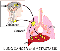 metstasis cancer