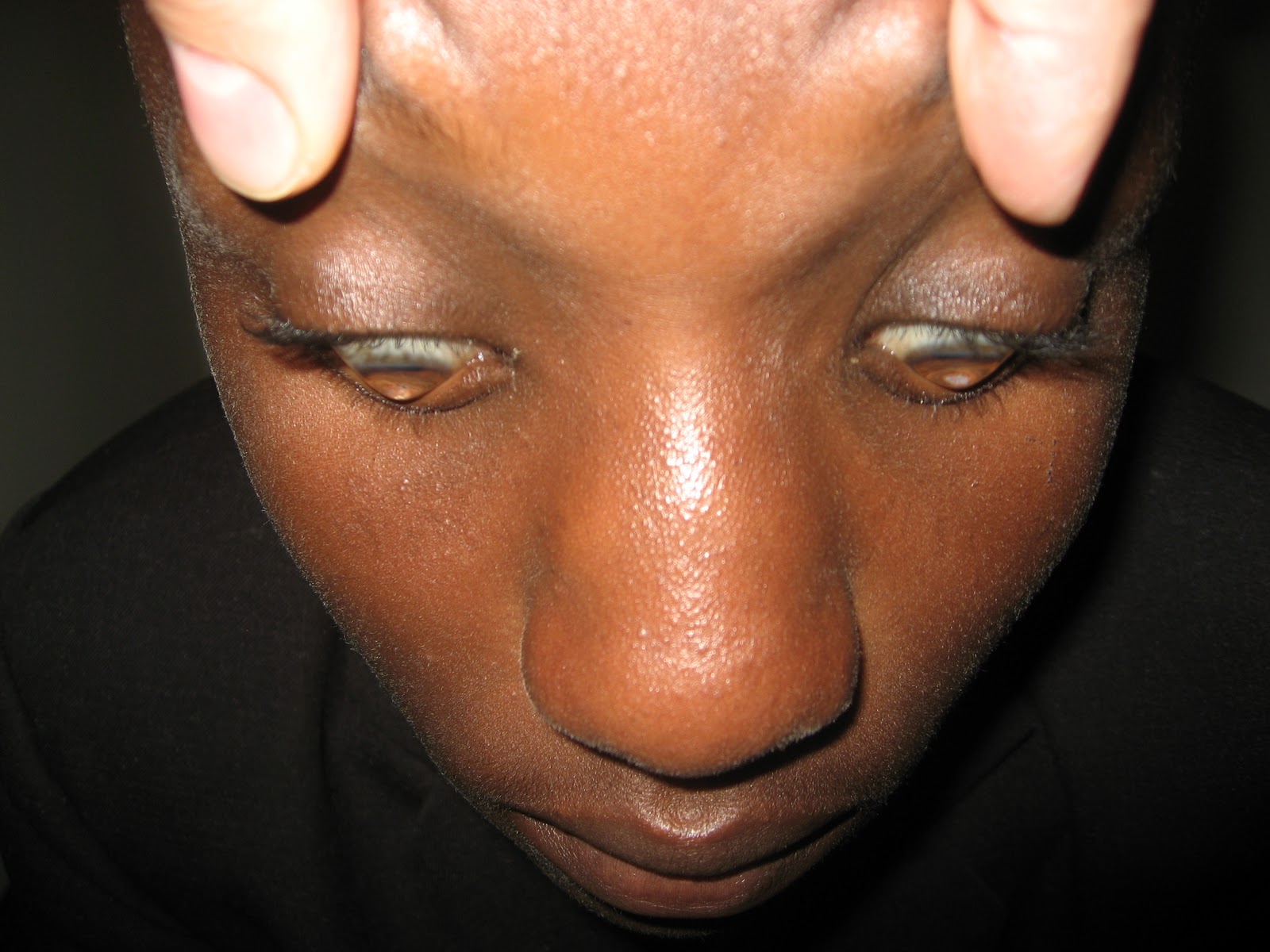 Word and Deed Case(s) of the Week Corneal Transplants