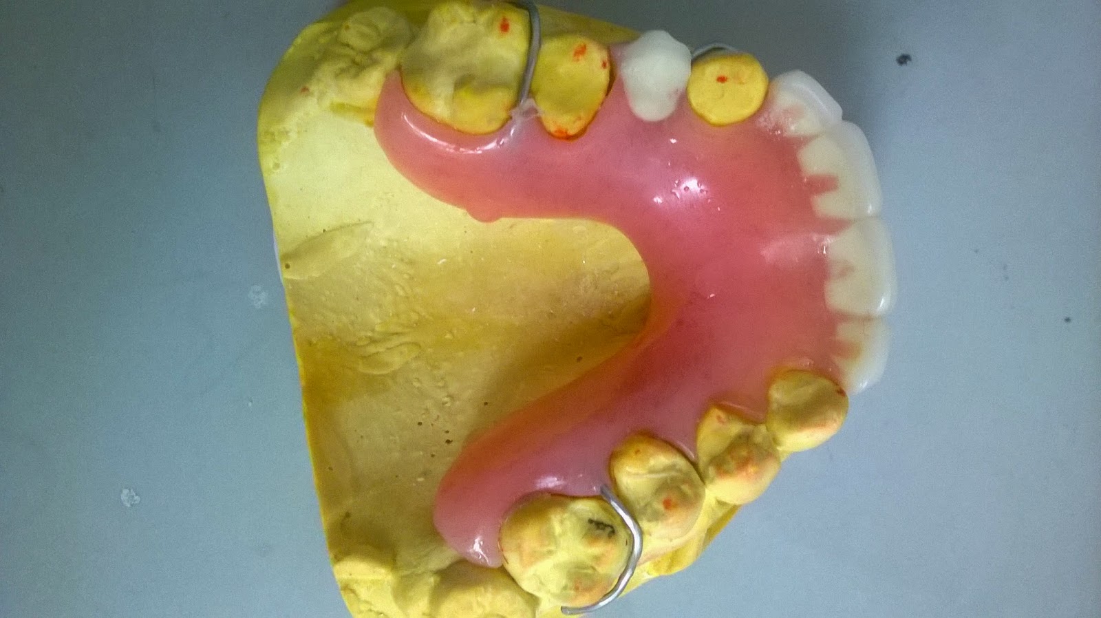 Denture and partial denture information What Is a Partial
