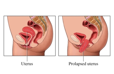Prolapsed Uterus Bowel Symptoms