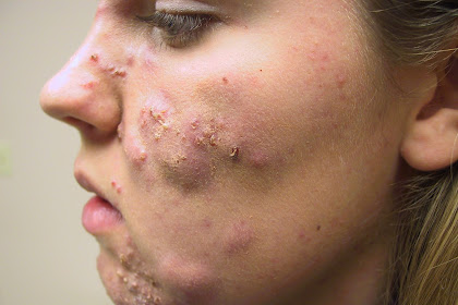 Medical Pictures Info \u2013 Types of Acne