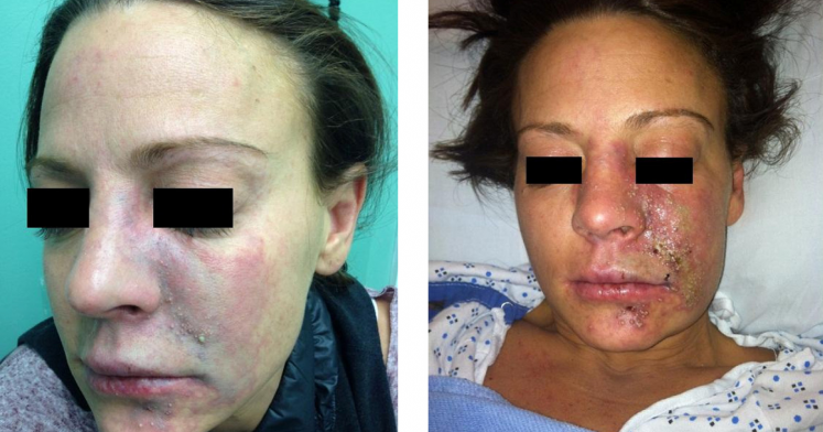 plastic surgery and its side effects Negative effects of cosmetic surgery this is partly due to the growing number of plastic surgeons and their negative effects include side effects. plastic surgery and its side effects Negative effects of cosmetic surgery this is partly due to the growing number of plastic surgeons and their negative effects include side effects.
