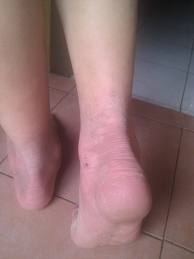 bệnh á sừng và cách điều trị