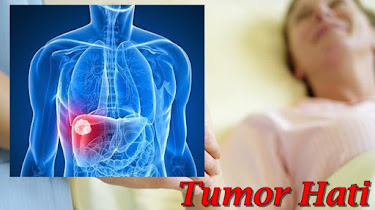obat tumor hati tradisional obat tumor hati tradisional
